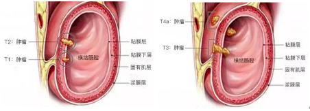阿特蒙李進教授：讀懂結直腸癌TNM分期及對應的治療方案